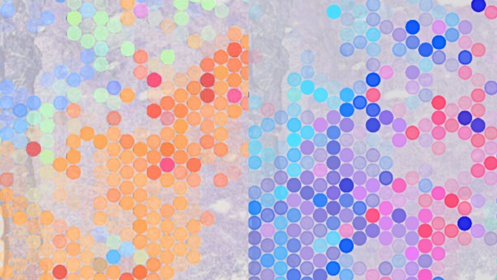 Spatial neighborhoods in colorectal cancer. Coloured dots show clustering annotations of different cancer cell states and stromal cell populations in the tissue. See Ogden et al. 2025 Figure 4 for more details.
