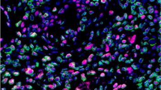 Germinal centre-like structures in the salivary glands of a patient with Sjögren’s syndrome. This microscopy image shows the relationship between molecules involved in the cell’s recycling process (autophagy; shown in red) and Lamin B1 (in green), a protein found at the edge of the cell nucleus. Areas with increased autophagy activity correspond to regions with lower amounts of Lamin B1, suggesting this recycling process helps control Lamin B1 levels in immune cells during autoimmune disease.